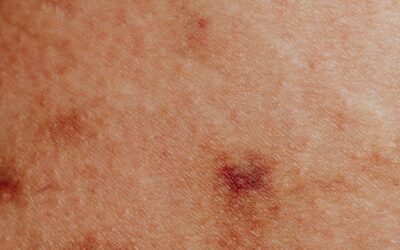 Can Hypnosis Help Prevent Hives?